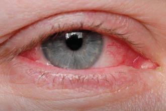 conjunctivitis