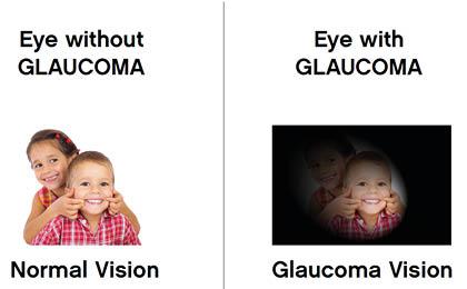 Glaucoma