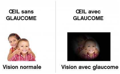 Glaucome